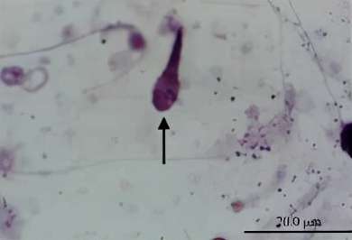 uu感染会自愈么,uu感染是hiv吗