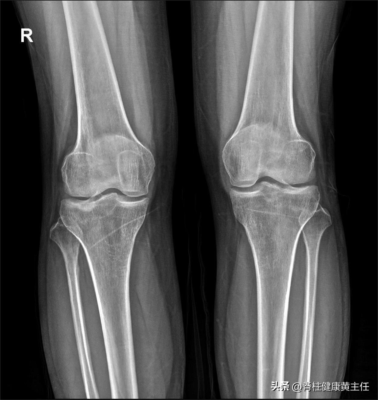 膝关节疼痛不是风湿是什么引起的,髌骨上移膝痛1分钟解决
