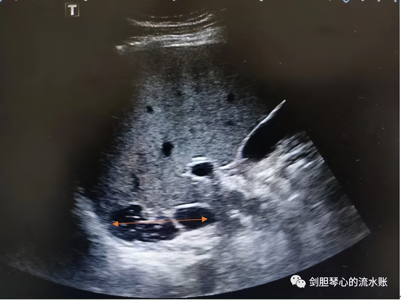 左肺下叶肺隔离症需手术吗,左肺下叶肺隔离症是什么意思