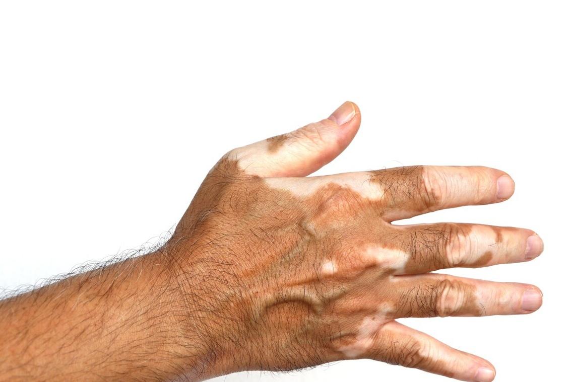 稳定期的白斑怎样快速复色,白斑复色成功