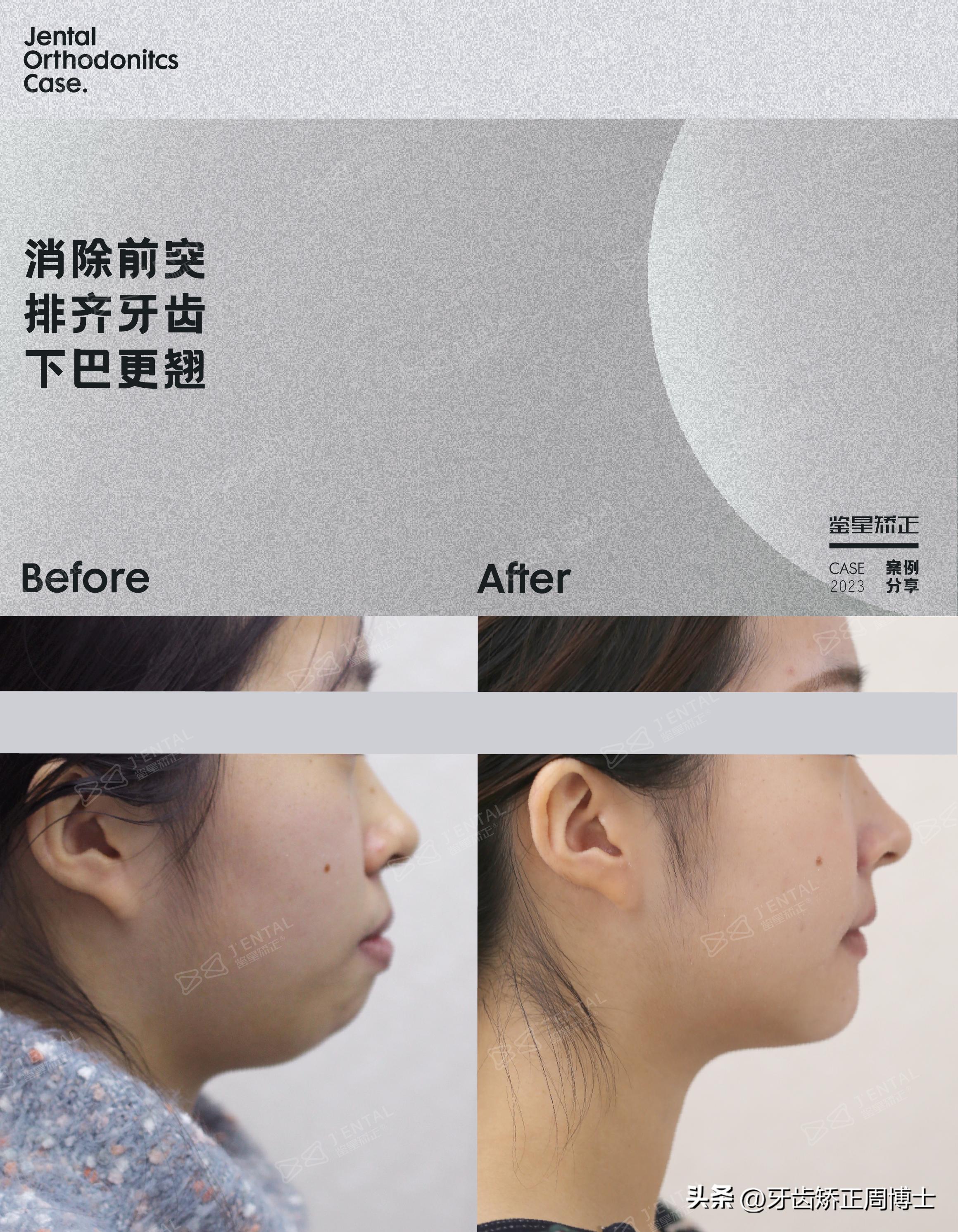 龅牙骨钉矫正演示,骨性龅牙打骨钉前后对比