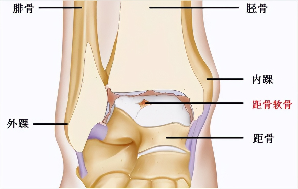 反复崴脚不重视得了创伤性关节炎,多次扭伤同一个位置怎么治