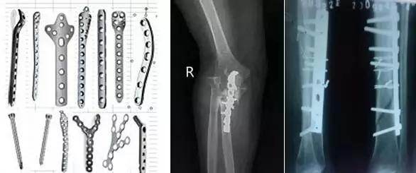 体内有金属植入患者怎么做核磁,体内有植入物可以做磁共振检查吗