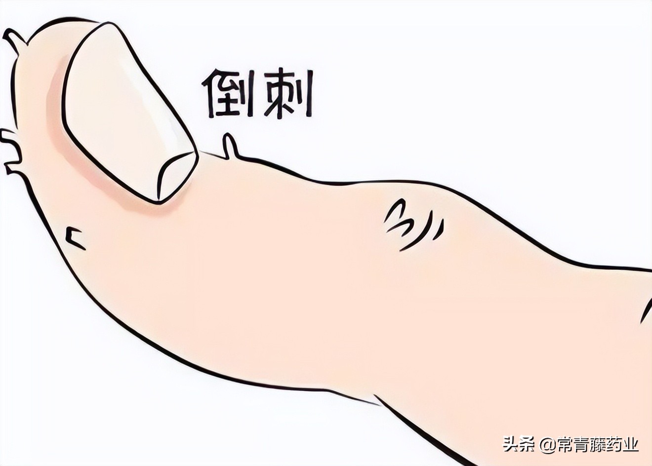 倒刺发炎痒,一直撕指甲怎么办