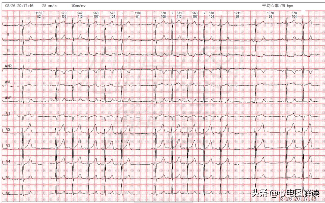 阵发性房性早搏是怎么引起的,房性早搏比阵发性房颤难治吗