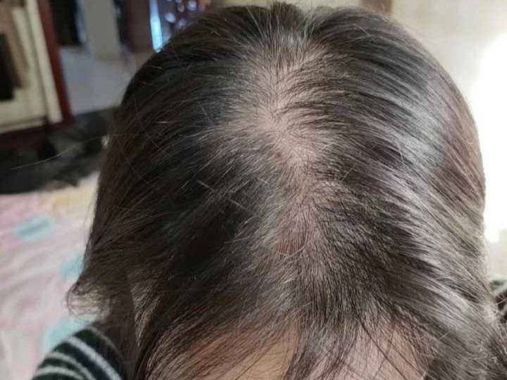 脱发为什么都是从头顶先秃,脱发为什么先从头顶脱