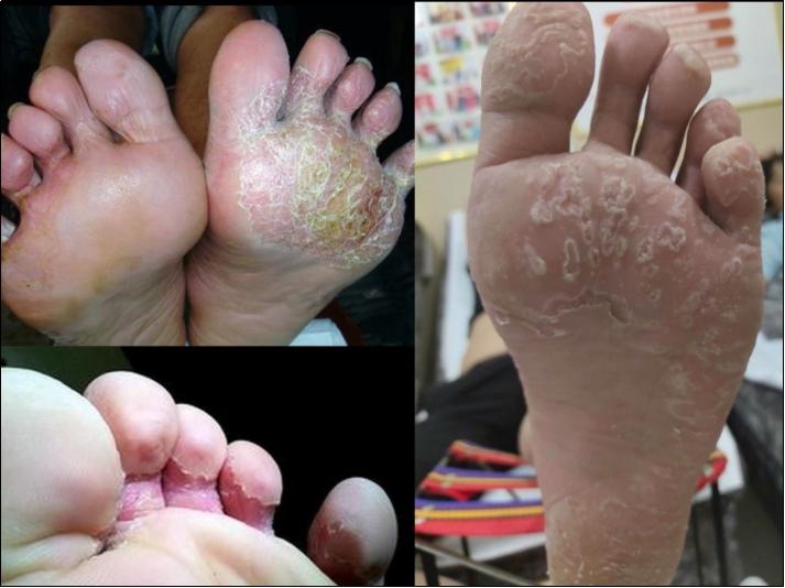 治脚气小生意,脚气加盟店