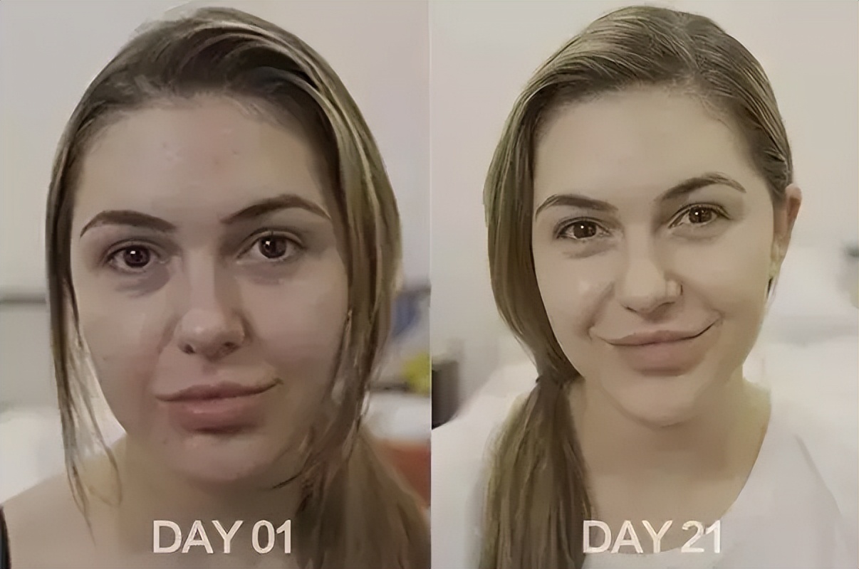 泰国女子打6年美白针六胜肽,女子打美白针后身患多病