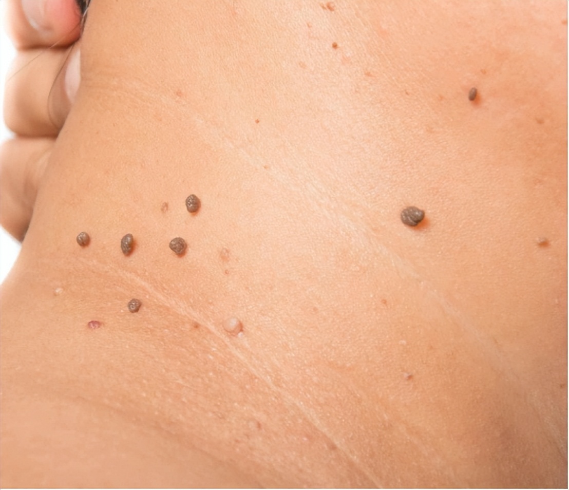 脖子上长小肉疙瘩丝状疣怎么治疗,脖子上长小肉疣怎么治疗