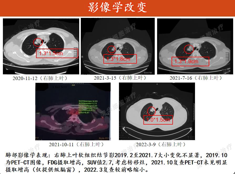 患癌20年经历2次转移最终抗癌成功,肾癌10年后发生转移