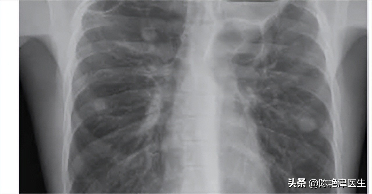 为什么医生不肯说肺大泡有多大,体检肺大疱是什么意思