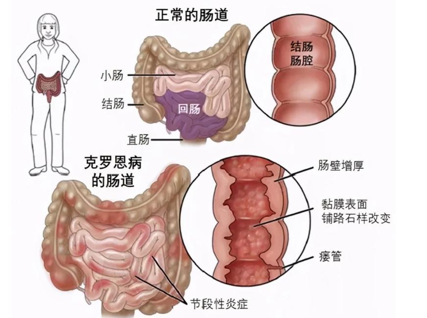 总爱放屁，是身体在排毒？医生：别再被误导了！或与3个原因有关