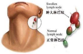 淋巴结肿大和炎症有关系吗,淋巴结肿大和淋巴结核有什么区别