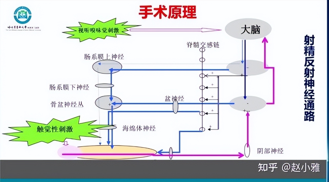 为了延时，阴茎背神经阻断术值不值得做？救命稻草还是治疗陷阱？