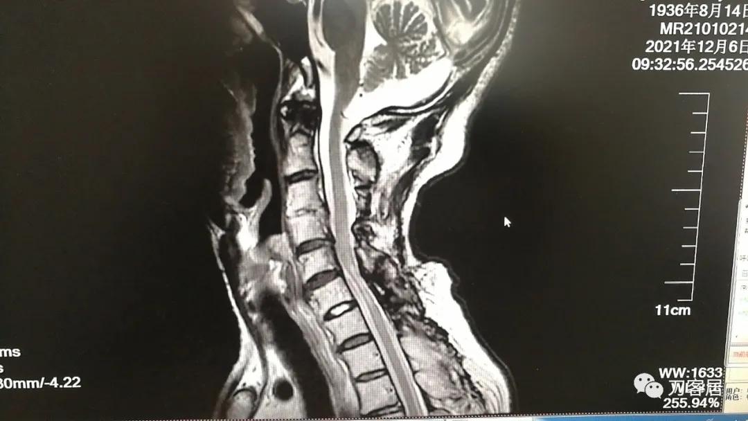 颈椎椎管内肿瘤手术20例麻醉处理,颈椎脊髓内肿瘤手术成功案例