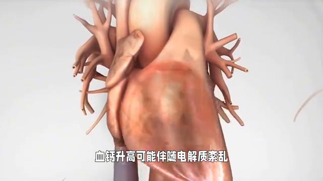 高钙血症是怎么引起的?,高血钙原因及处理方法