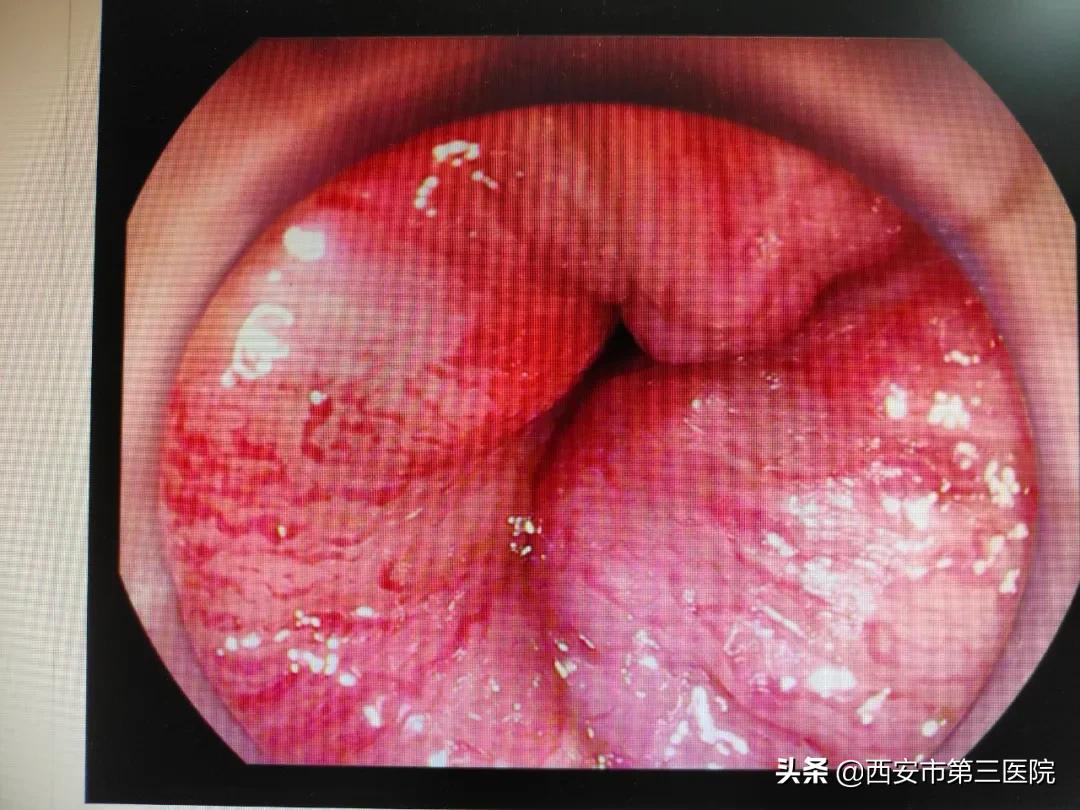 内痔出血多会导致贫血吗,内痔出血伴有贫血怎么办