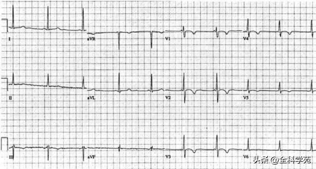 t波倒置三种常见原因,t波低平倒置有事吗