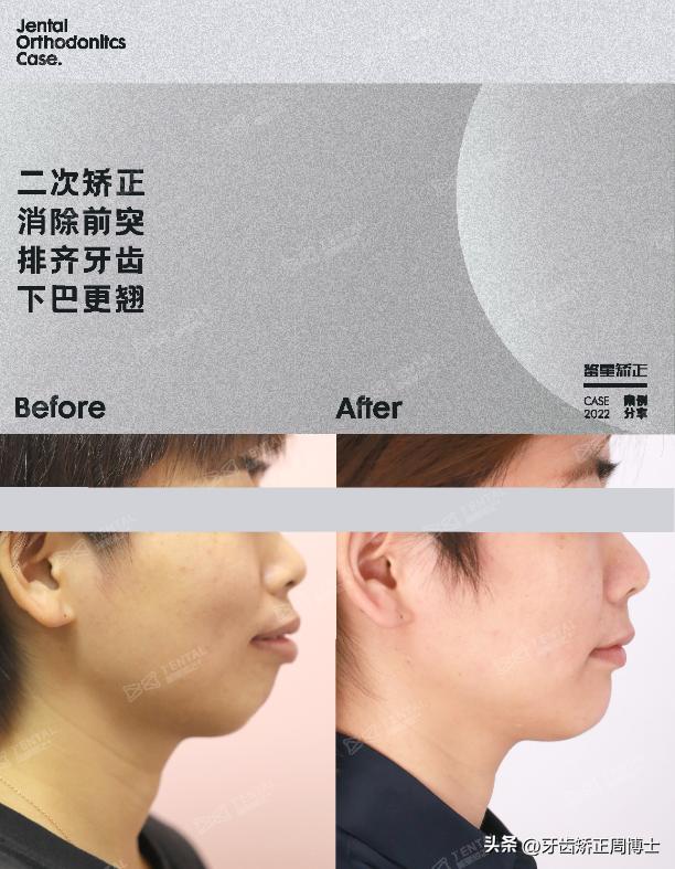 早期矫正下颌往前伸怎么纠正,改善正畸后锁颌方法