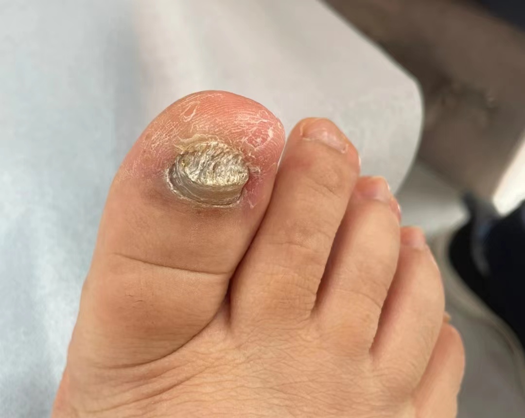 灰指甲到底怎么才能彻底治好,灰指甲用什么方法能彻底根除