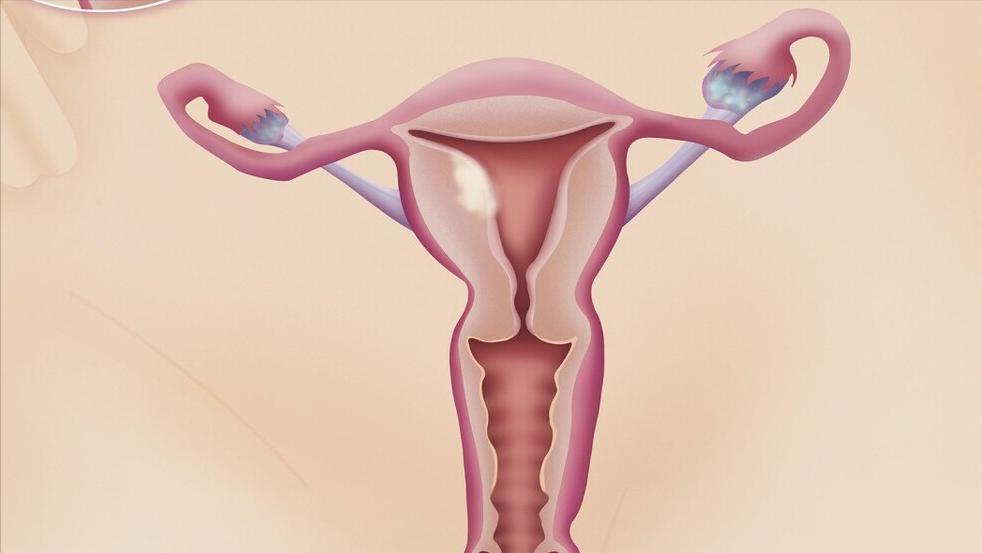 子宫内膜偏厚中医怎么治,绝经子宫内膜厚癌变几率大吗