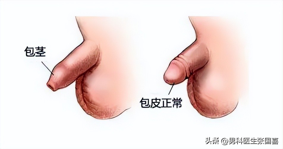 包皮长是不是一定要切掉,包皮过长一定要割掉吗23岁