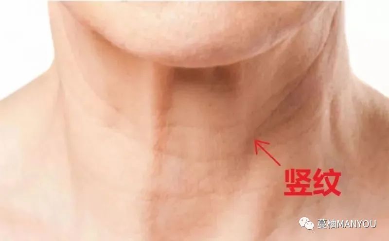 颈纹特别深怎么消除,颈纹很深的如何淡化颈纹