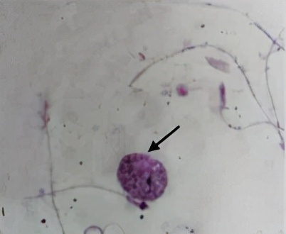 uu感染是什么意思,uu感染严重吗