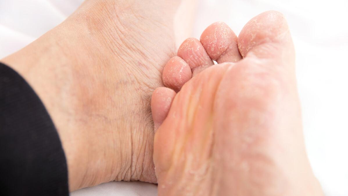 脚气用喷雾还是药膏好得快,脚气很痒可以频繁涂药膏吗