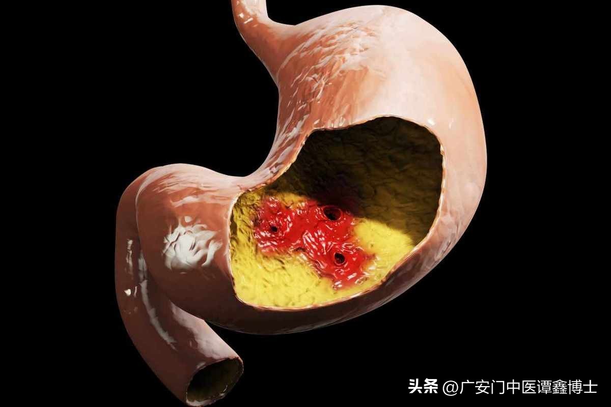 让胃癌患者晚期减少痛苦的方法,中期胃癌的治疗方案