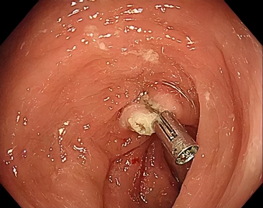 胃肠息肉切除后注意什么,胃肠息肉切除手术后注意事项