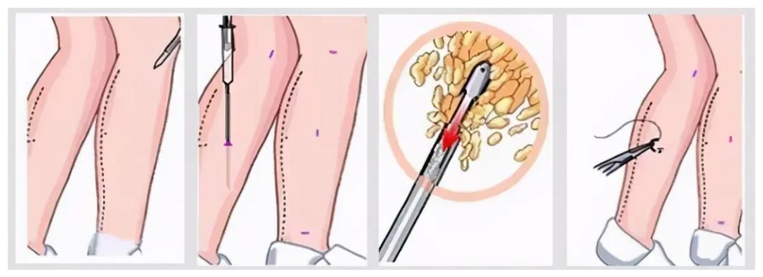 九院韦敏隆鼻相关科普第二期,九院韦敏手术案例