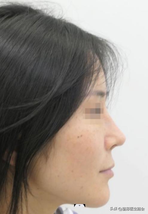 隆鼻到底要不要只做鼻头,隆鼻前要检查哪些项目