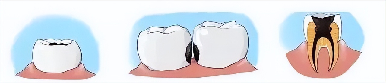 口腔中的隐身高手——邻面龋？