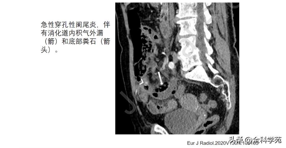 阑尾炎的讲解,关于阑尾炎的讨论总结