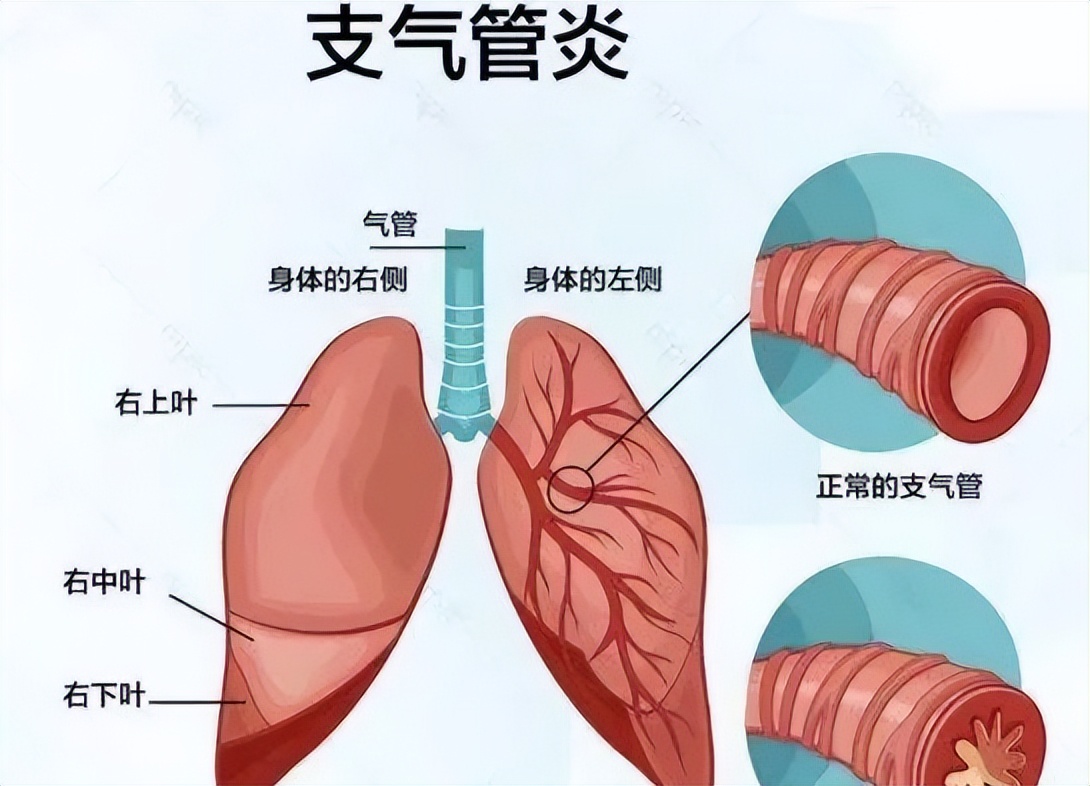 秋季过敏性哮喘几月开始用药,过敏性鼻炎和过敏性哮喘联合用药