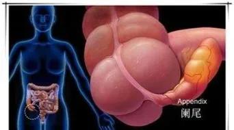 急性阑尾炎手术切除教学视频,急性阑尾炎总结