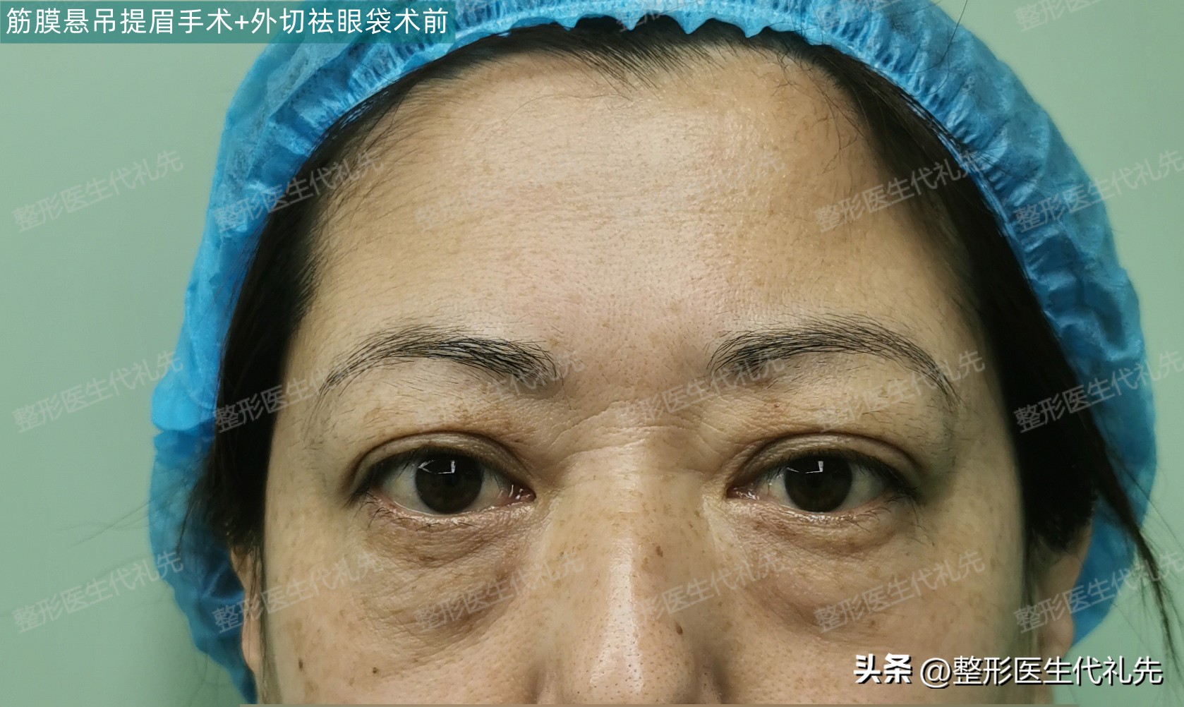 眼袋的原因及消除方法,眼袋是什么原因怎么去除