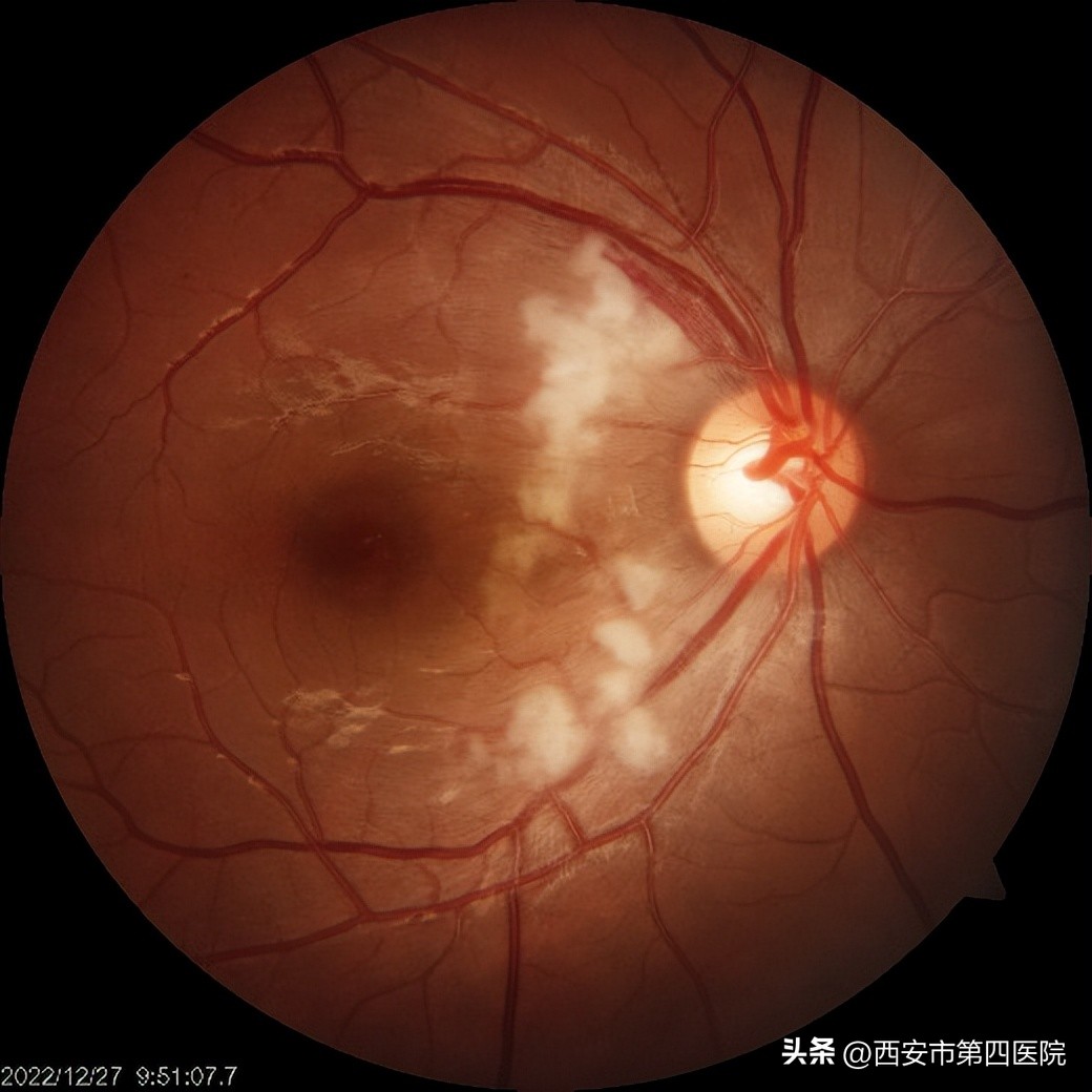 #新冠防疫手册#33岁女士“阳康”后视力下降、模糊、黑影……