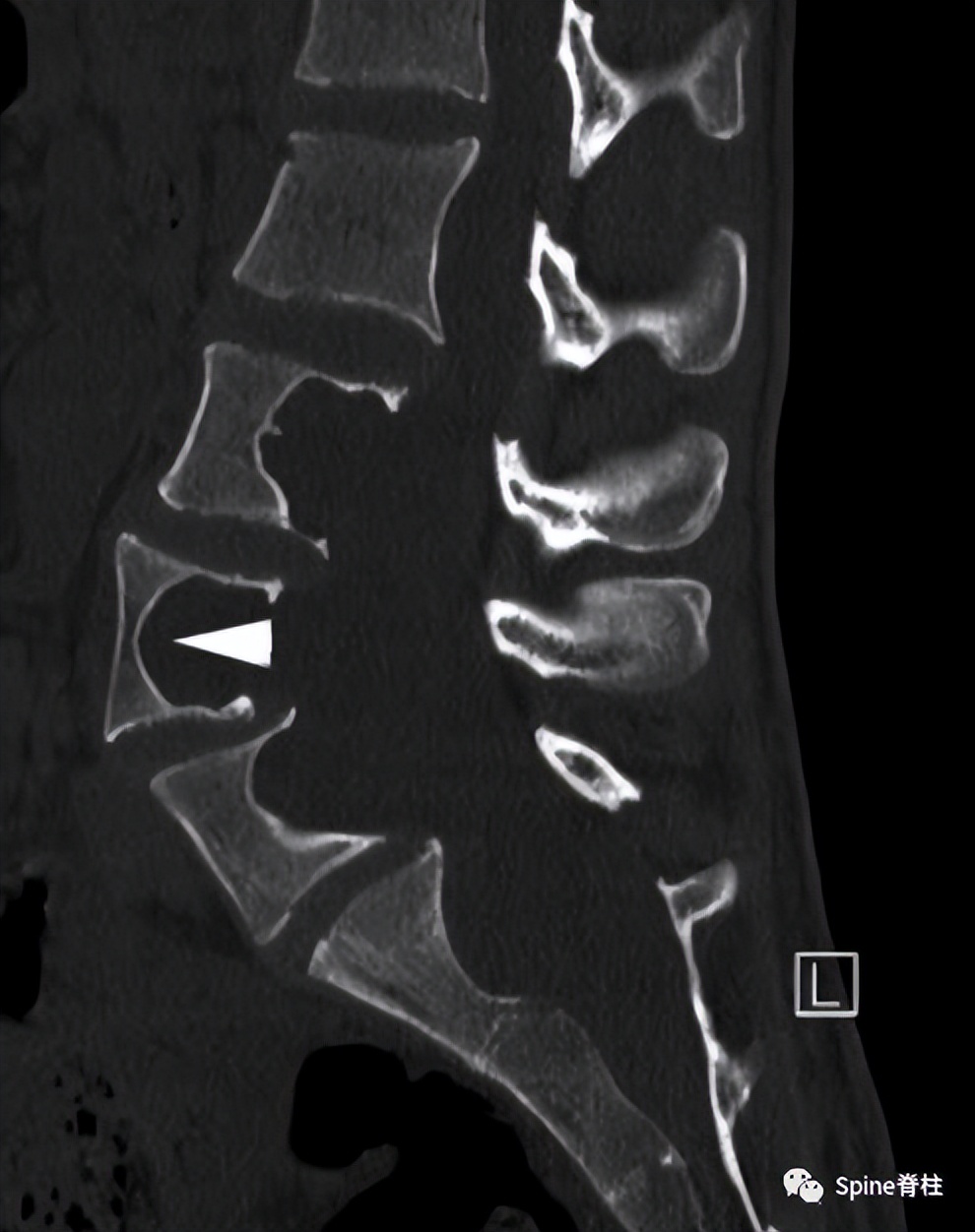 硬膜囊扩张是什么意思,硬膜囊扩张压迫神经