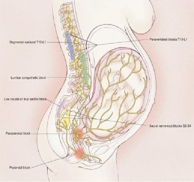 医生，为什么打了分娩镇痛我还痛？