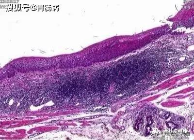 嗓子干痒、有异物感...当成咽炎，差点要命