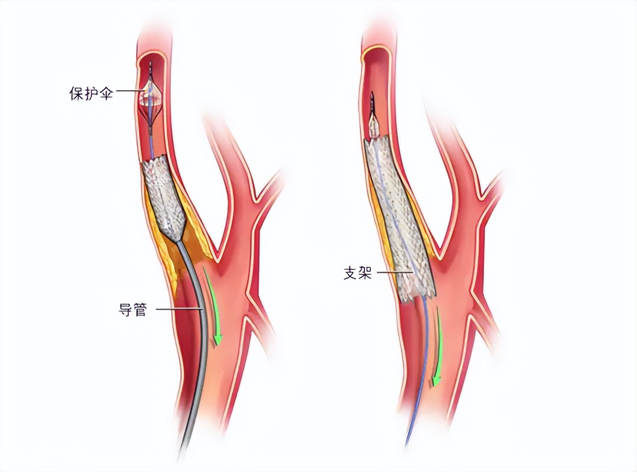 脑梗患者舌底取栓,脑梗取栓是最佳治疗方法吗