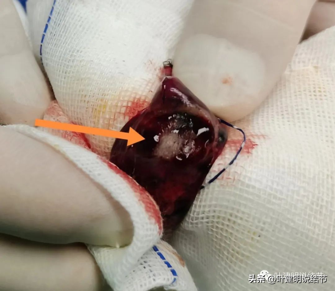 右下叶磨玻璃6mm结节基本上是癌,右下叶少许炎症上叶磨玻璃结节