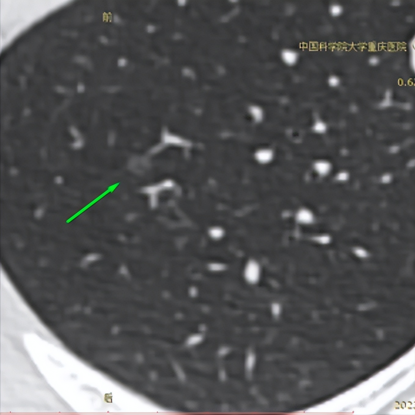 多发、混磨加高危找上门，她该如何？有我在，永宜厥身，保寿命只
