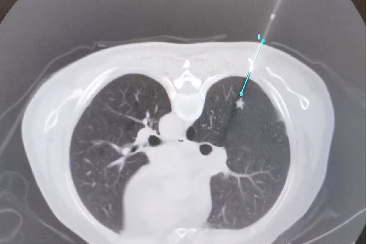 经皮肺活检术,经皮环肺静脉射频消融术名词解释