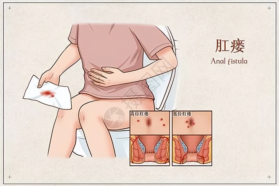 久坐怎么防肛瘘,湿热会导致肛瘘吗怎么预防