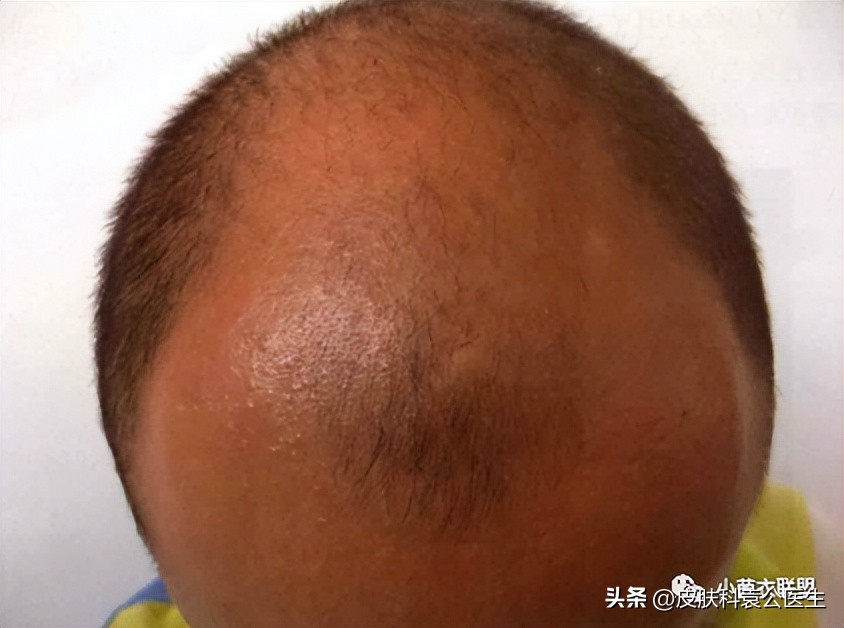 皮肤病忌口发物都包括牛奶吗,发物忌口期间吃什么比较好