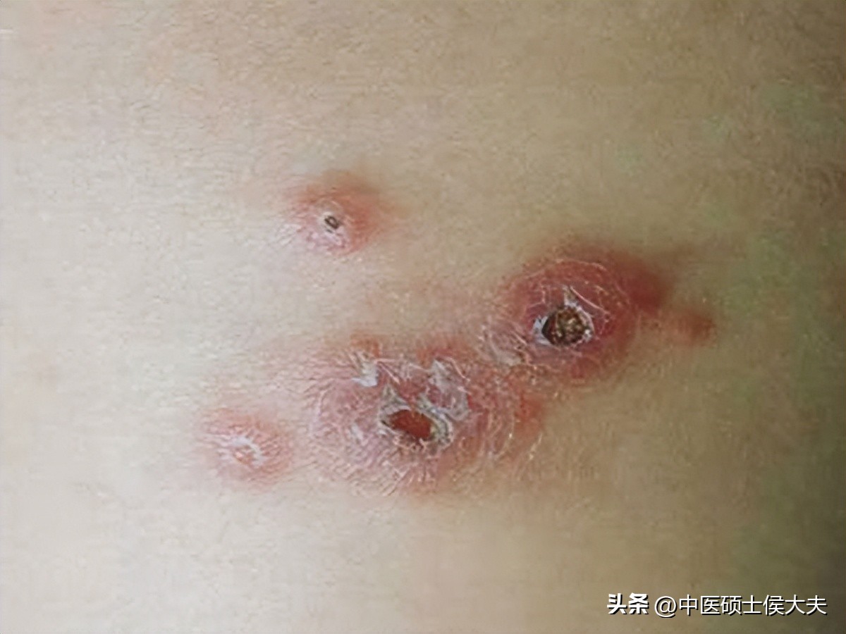 逍遥丸这样用，不仅健脾，还能化瘀散结，祛除痰湿，肝肾同调