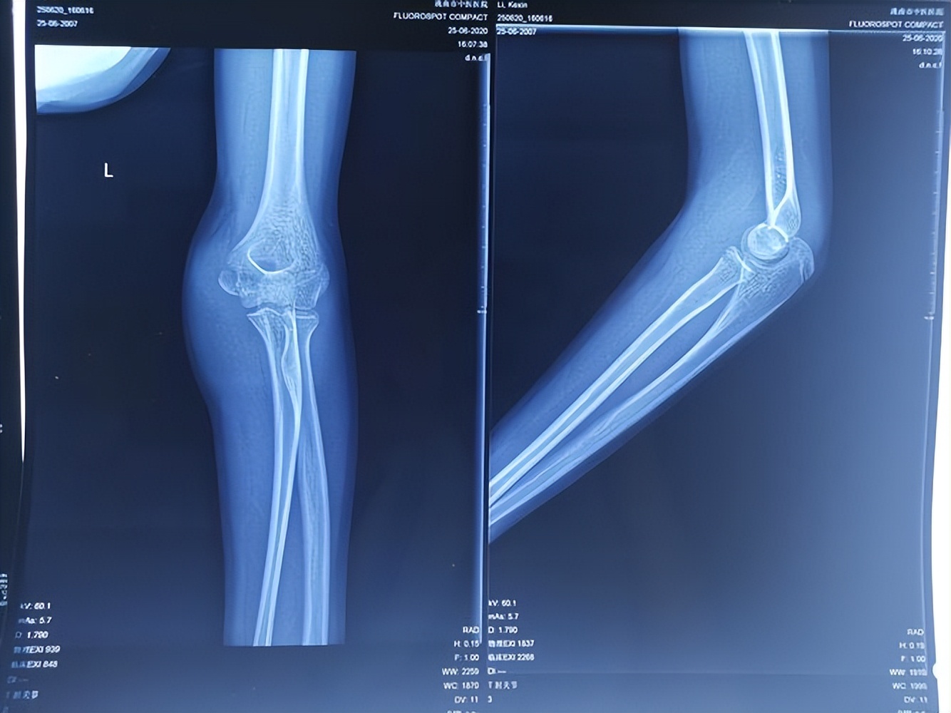 儿童股骨干粉碎性骨折对位不太好,儿童股骨干骨折石膏固定